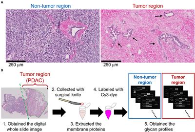 Discovery of Pancreatic Ductal Adenocarcinoma-Related Aberrant Glycosylations: A Multilateral Approach of Lectin Microarray-Based Tissue Glycomic Profiling With Public Transcriptomic Datasets